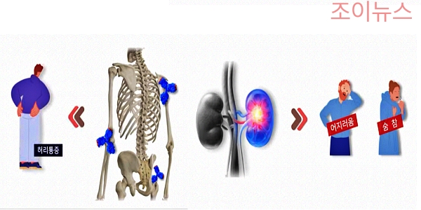 다발성 골수종의 증상, 신부전, 뼈 통증
