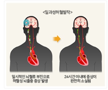 일과성허혈발작-출처:국가건강정보포털