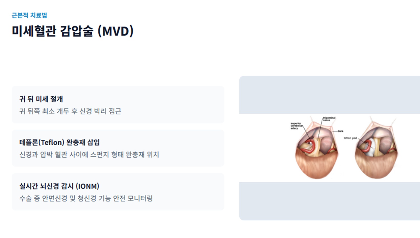미세혈관감압술