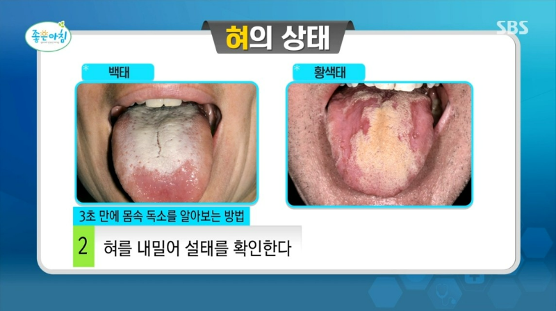 만성 염증 자가진단법