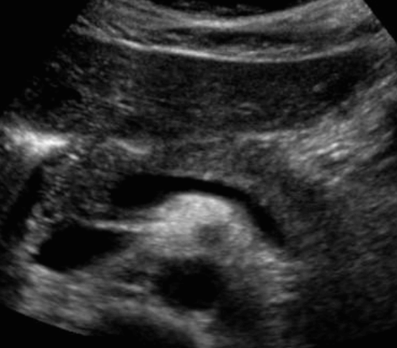 정상췌장의 초음파적 소견