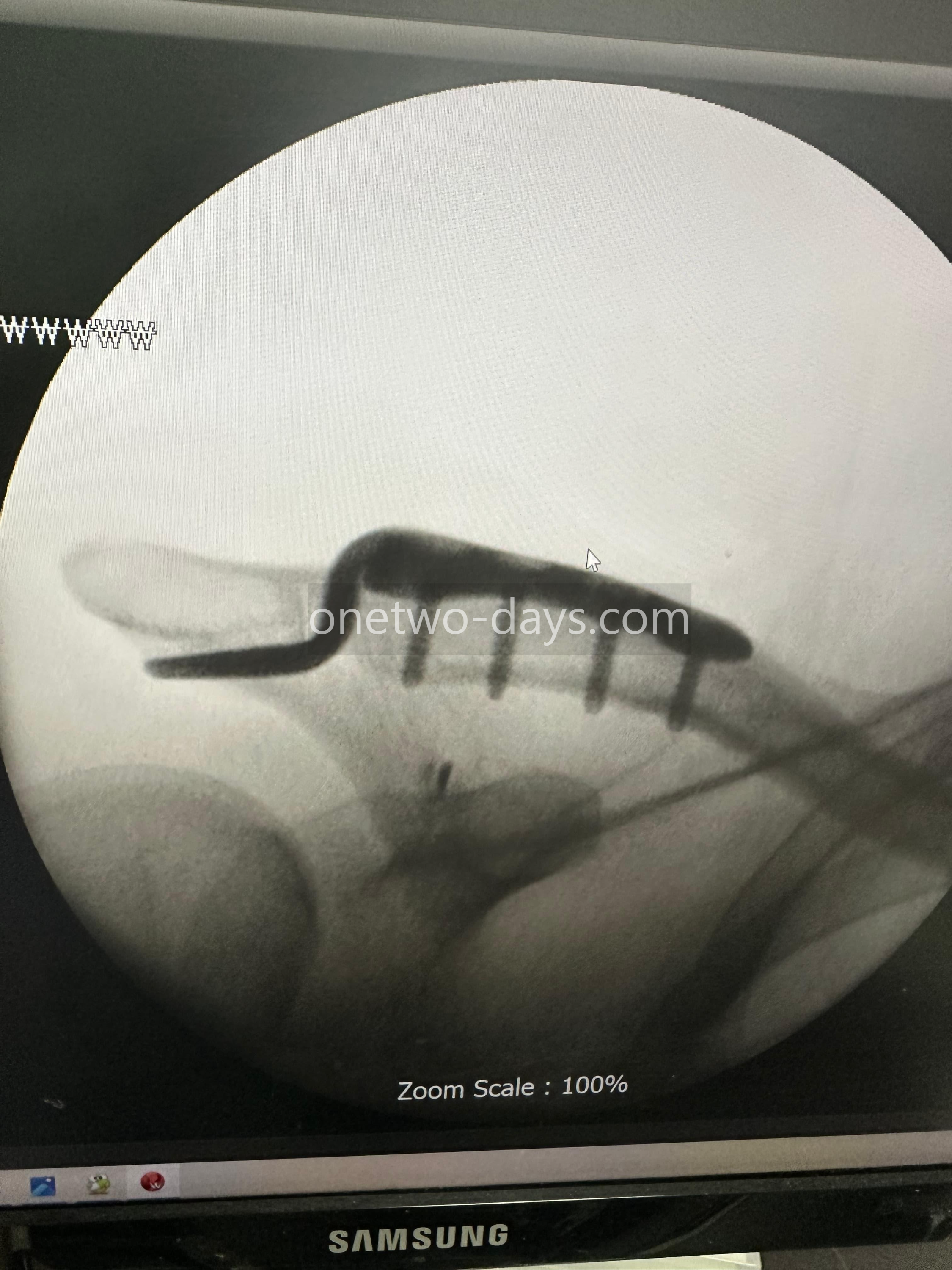 후크 플레이트 수술 후 X-ray