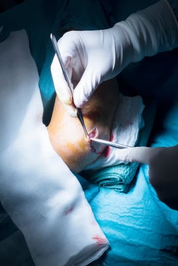 팔꿈치 내측 융기 절제술: 척골 신경 압박 증후군 치료법