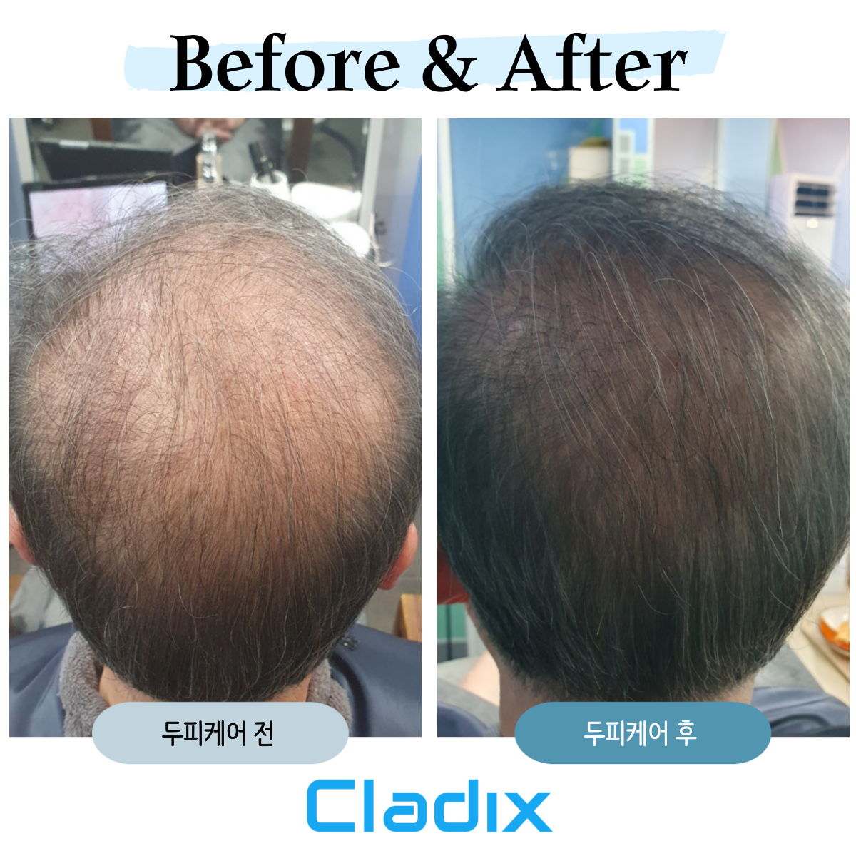 클라딕스두피케어