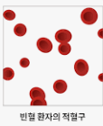 철분 결핍과 대장암 : 빈혈 원인