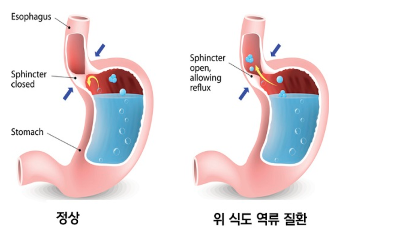 역류성 식도염 스트레스