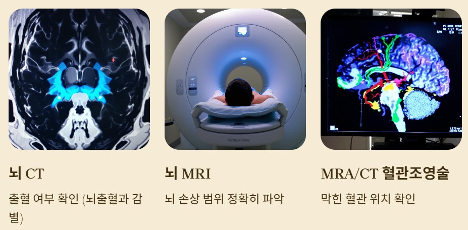 뇌경색 진단과 치료