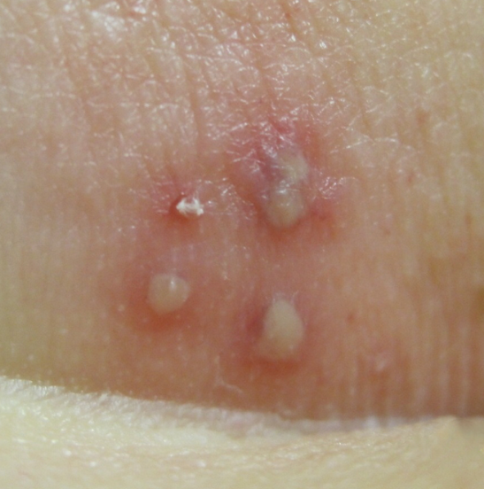 헤르페스 2형 증상