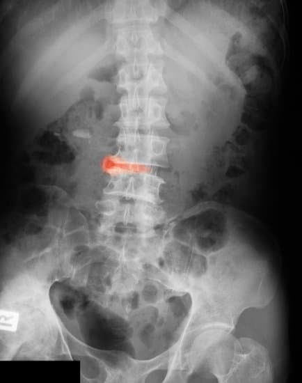 강직성 척추염(Ankylosing Spondylitis): 원인, 증상, 치료 및 관리법