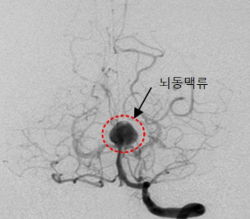 뇌동맥류이미지