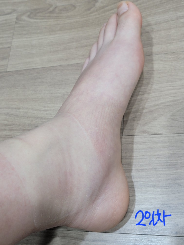 발목-접질렀을-때