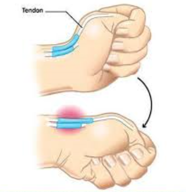 건초염-자가-체크-방법