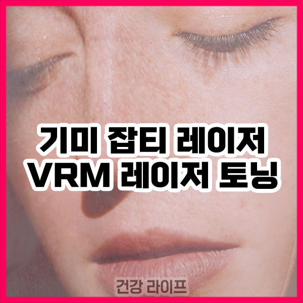 기미 잡티 레이저