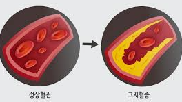 고지혈증 증상 2