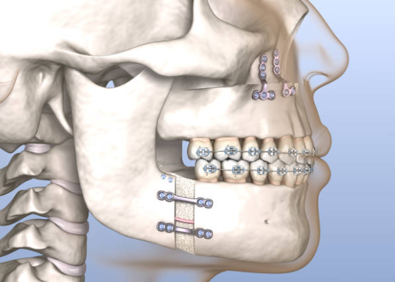 양악수술
편악수술
주걱턱
무턱
수면무호흡
코골이
전신마취