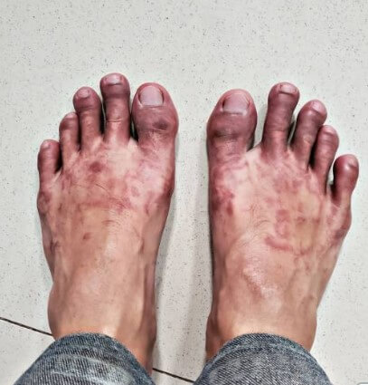 동상증상-동상원인