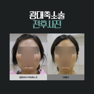 옆광대축소주사