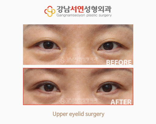 강남비중격만곡증