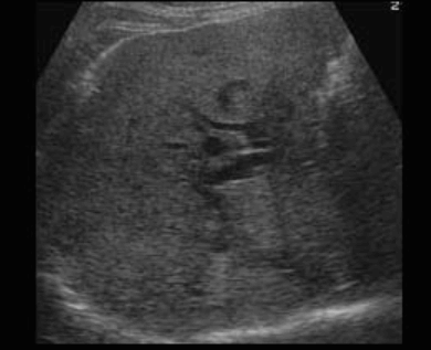 간내담관암(intrahepatic cholagiocarcinoma)