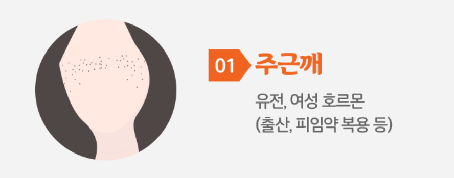 주근깨에 대한 설명 및 원인