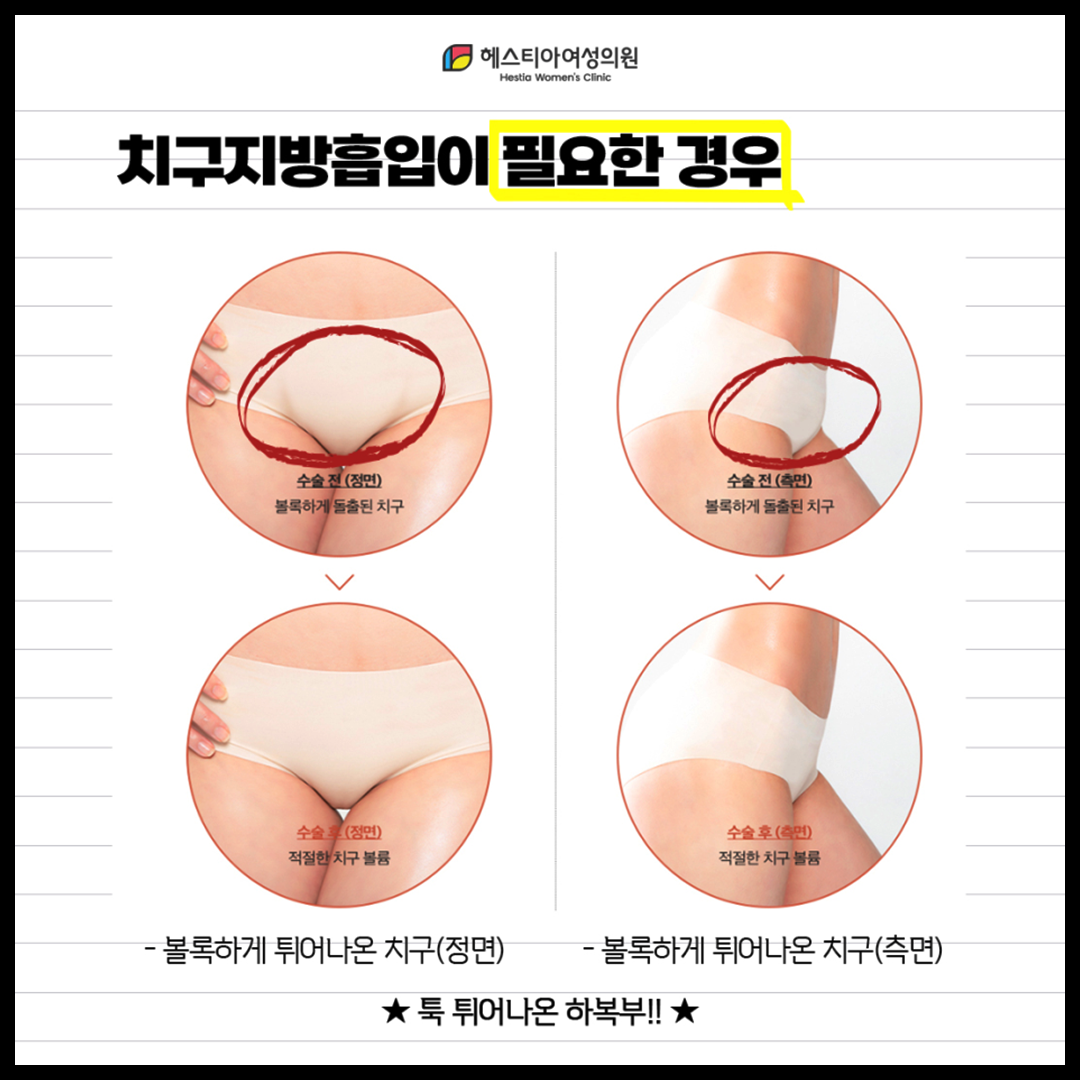 치구지방흡입이 필요한 경우