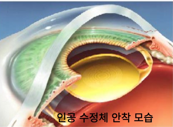 백내장 수술 방법-인공수정체 자리잡은 모습