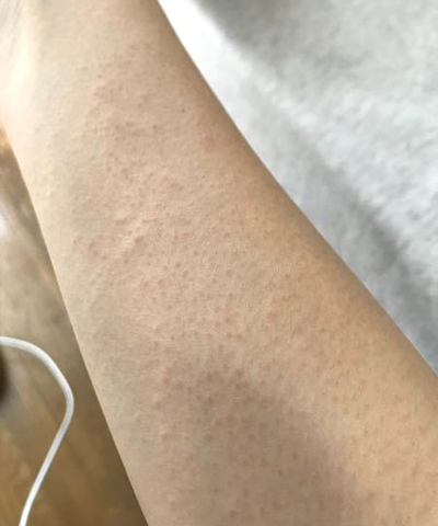 팔 좁쌀 두드러기