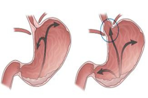역류성 식도염 이미지