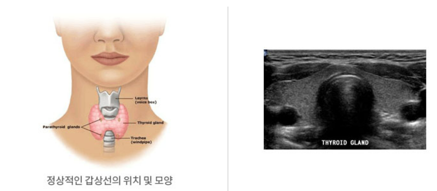 갑상선암 원인, 증상, 검사, 수술