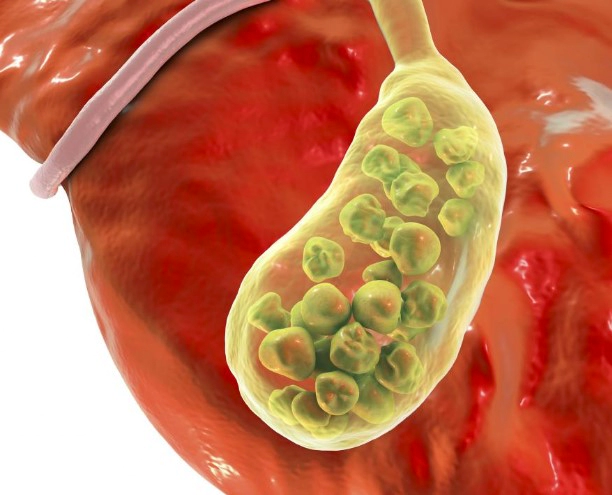 담낭염 증상 5가지 및 담낭염의 좋은 음식 추천