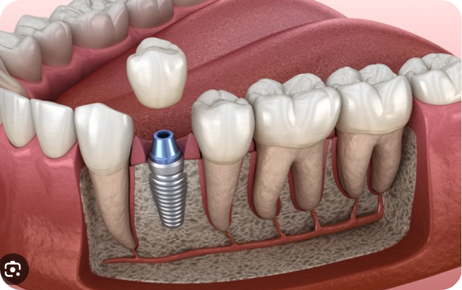 임플란트 시술방법