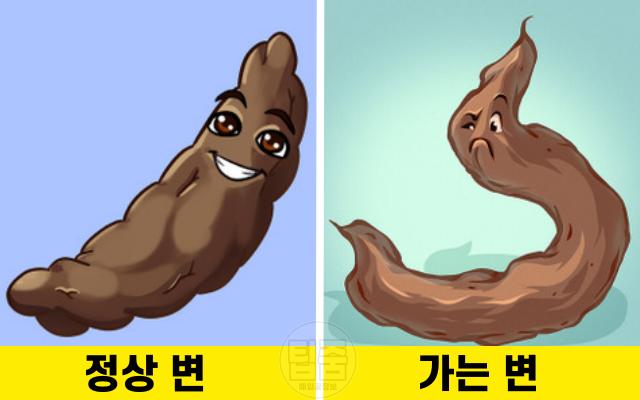 대장암 전조증상 4기 대장암증상 변모양