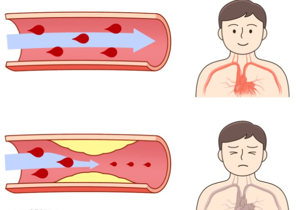 정상 혈관과 고지혈증 혈관 비교 이미지
