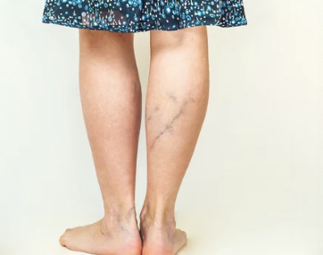 하지정맥류 수술