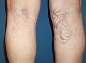 하지정맥류 증상