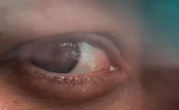 65세 이상 대상포진 예방접종 무료 혜택|신청 방법과 주의사항