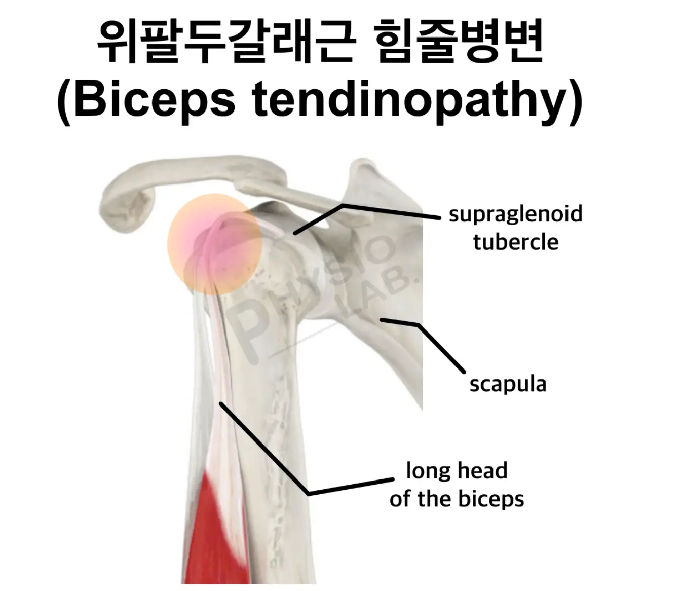 위팔두갈래근 힘줄병변: 원인, 증상 및 효과적인 치료법 총정리