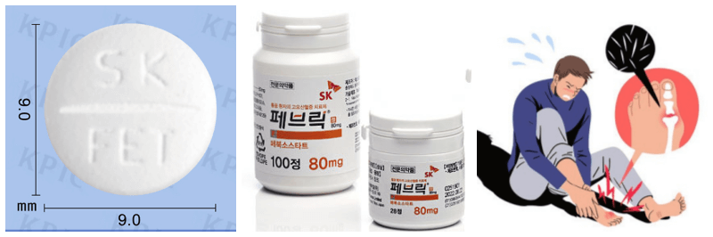 페브릭정, 통풍 사진