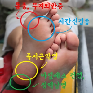 발바닥통증의 원인