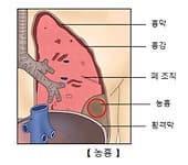 폐렴 증상