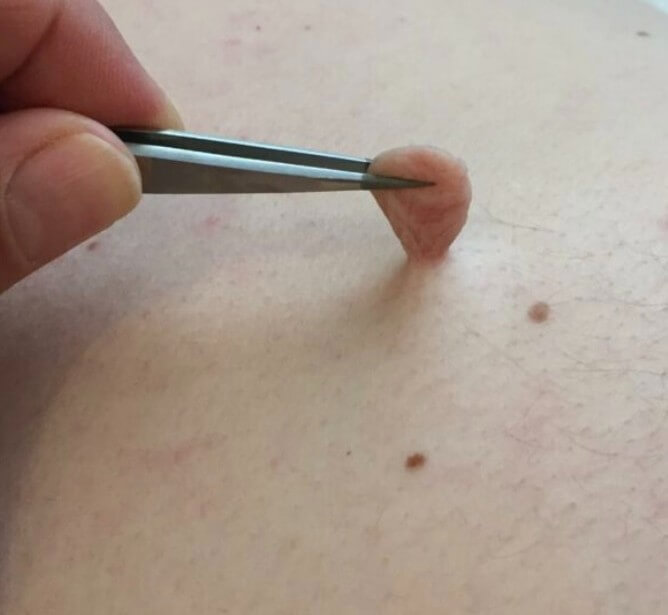 쥐젖을 제거하는 모습