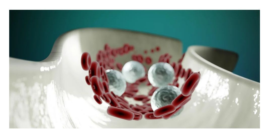 동맥경화증 초기증상