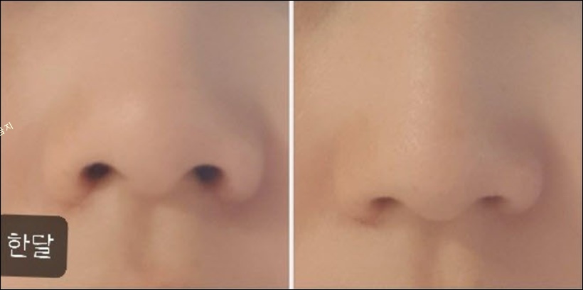 콧볼축소 수술 후