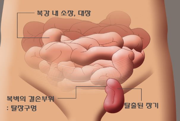3. 탈장 수술의 종류와 절차