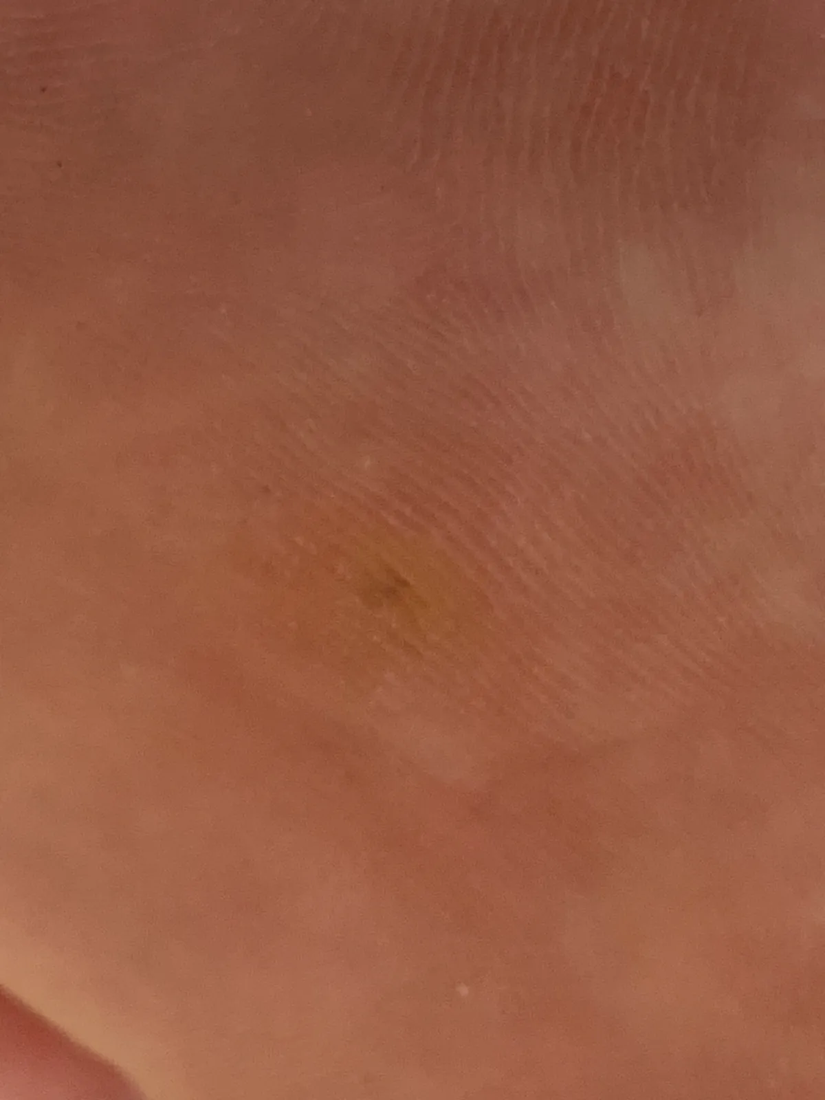 티눈밴드-사용전-발