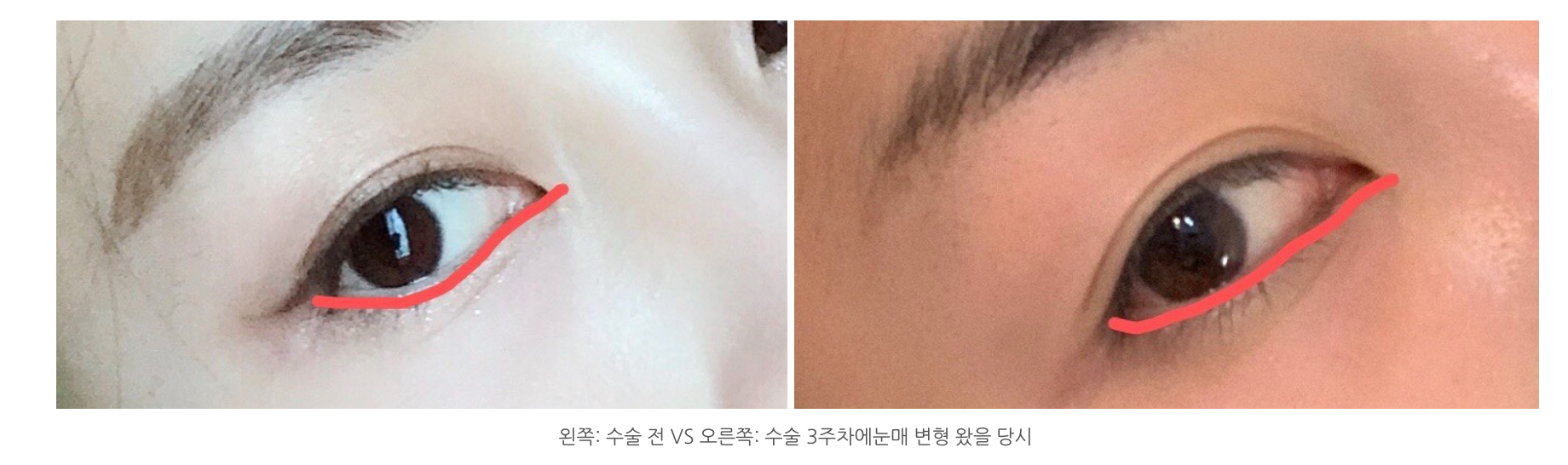 눈밑지방재배치 후기