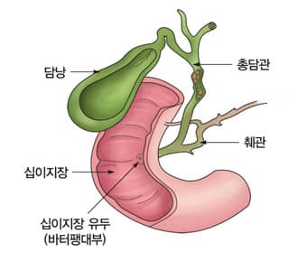 GLP-1 다이어트 약물과 담석 형성 위험 &ndash; 위고비&middot;마운자로 사용 시 주의할 점