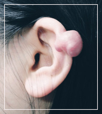 켈로이드
