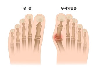 무지외반증 - 7가지 원인과 치료 및 예방 방법
