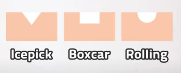 함몰 흉터 예시